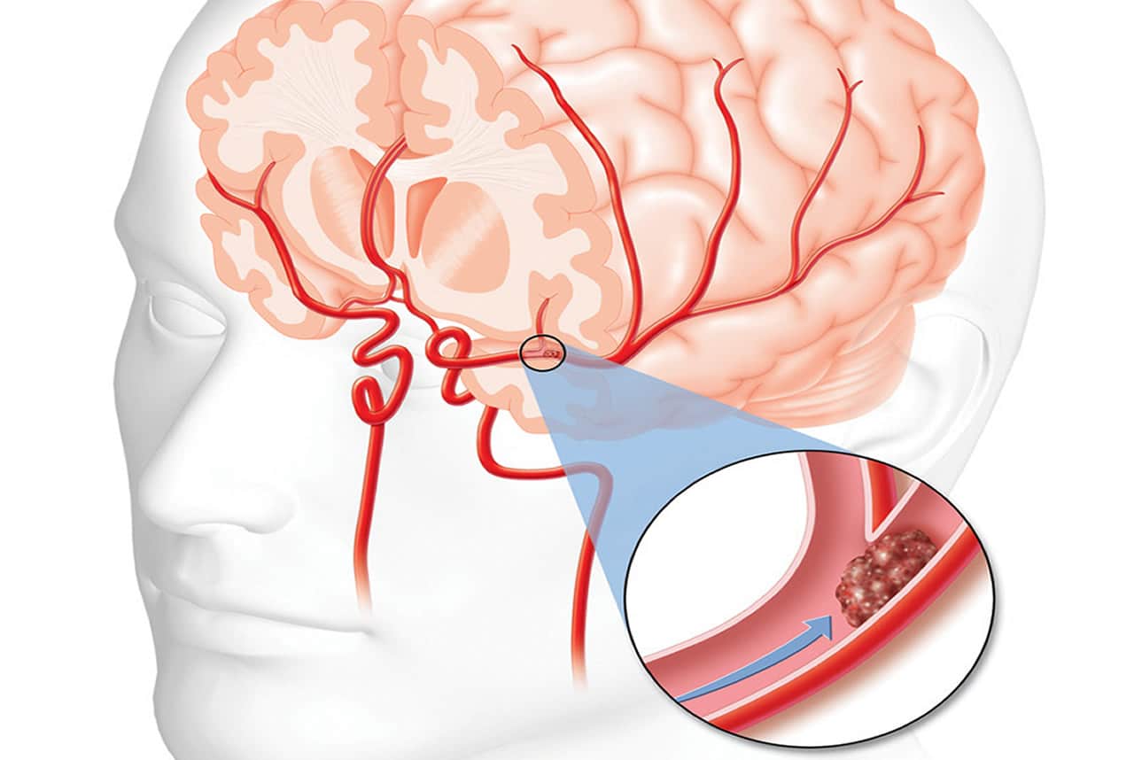 enfermedad-cerebrovascular