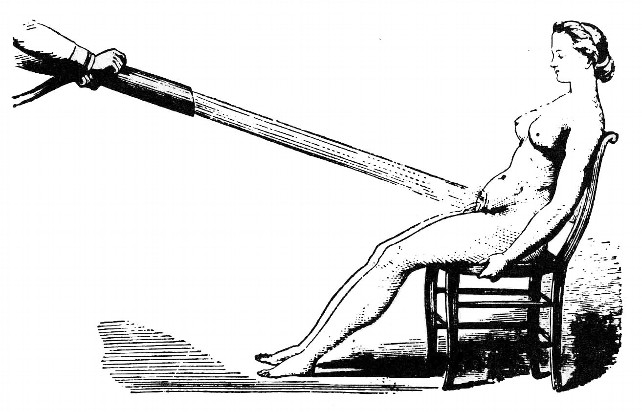 Duchas vaginales como tratamiento para la histeria. // Wikimedia Commons